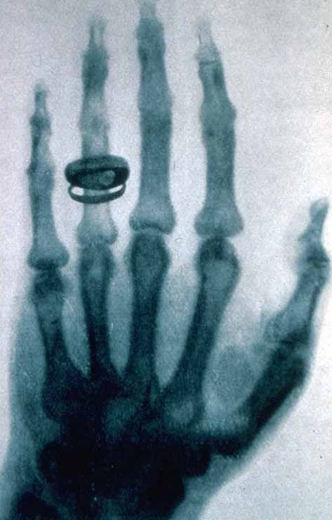 Première radiographie de Wilhelm Rontgen,